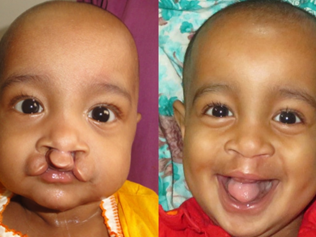 Vorher-Nachher Bild einer gelungen Operation einer Lippen-Kiefer-Gaumenspalte bei einem Kind